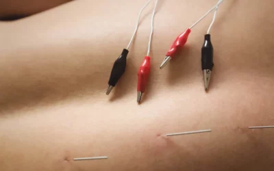 Preventing Hip Flexor Pain with Dry Needling